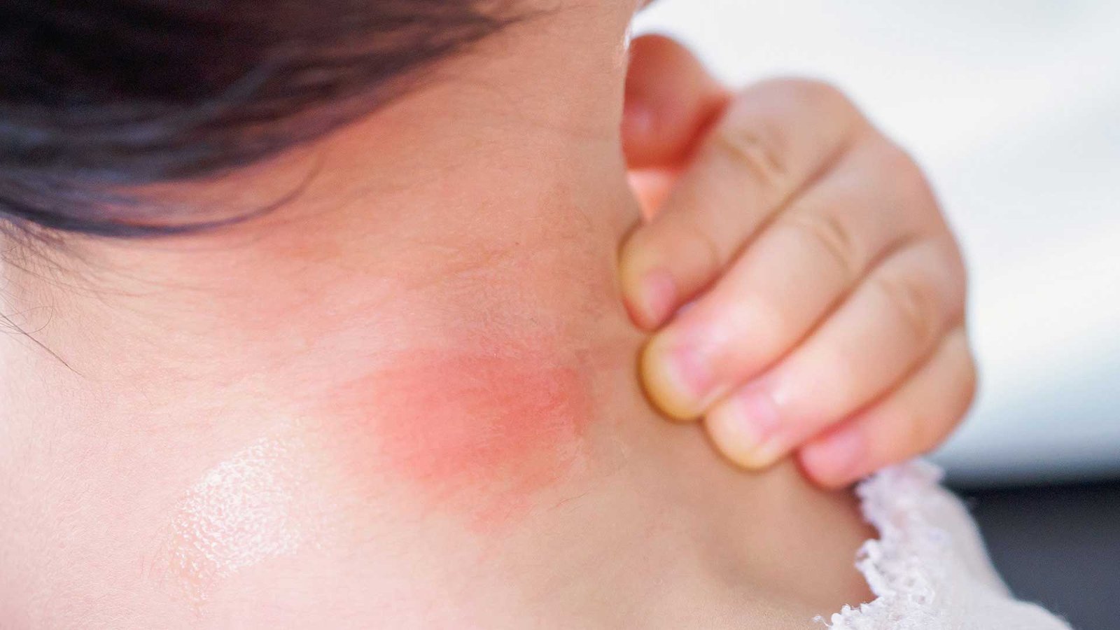 The Ways You Can Get Rid Of Mosquito Bite Marks